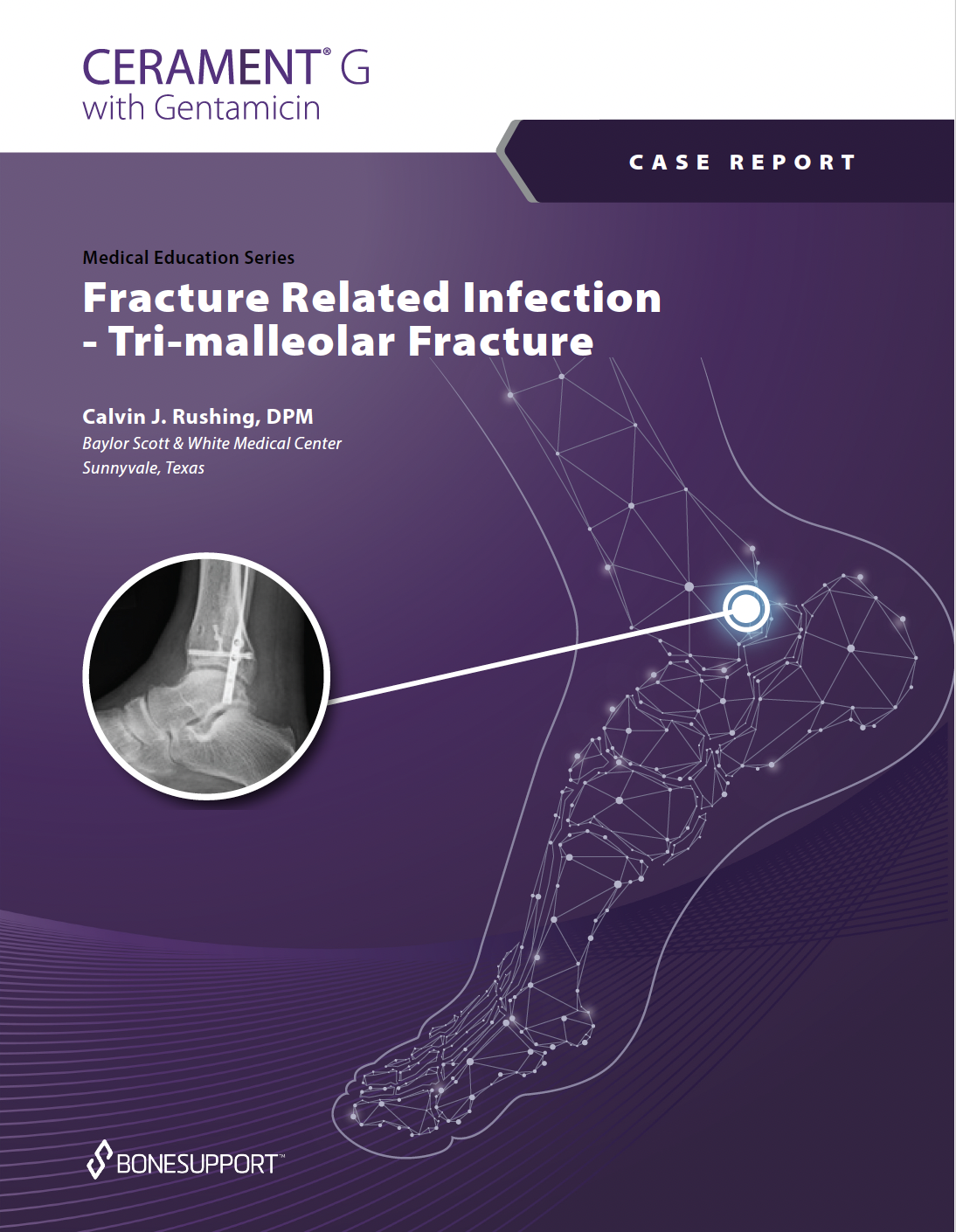 Fracture Related Infection – Tri-malleolar fracture
